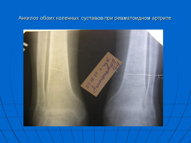 Анкилоз обоих коленных суставов при ревматоидном артрите.